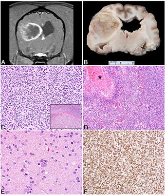 Canine Primary Intracranial Cancer: A Clinicopathologic and Comparative Review of Glioma, Meningioma, and Choroid Plexus Tumors